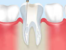 神経まで虫歯が進行したら根管治療を行います