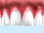 歯ぐきの黒ずみを解消する方法～ガムブリーチ～