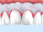 歯ぐきの黒ずみを解消する方法～ガムブリーチ～