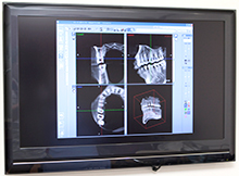 【～歯科用CTで、親知らずの状態を正確に診断することができます～】