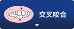 交叉咬合